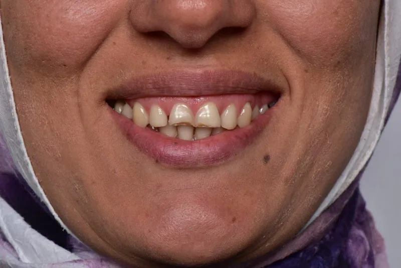 ÖNCE